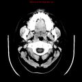 Neuroglial cyst (Radiopaedia 10713-11185 Axial non-contrast 33).jpg