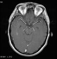 Neurosarcoidosis (Radiopaedia 10930-17204 Axial T1 C+ 7).jpg