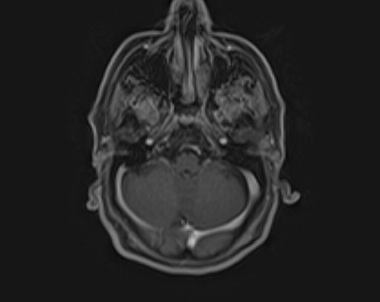 File:Non-Hodgkin lymphoma - parotid gland (Radiopaedia 71531-81890 E 46).jpg