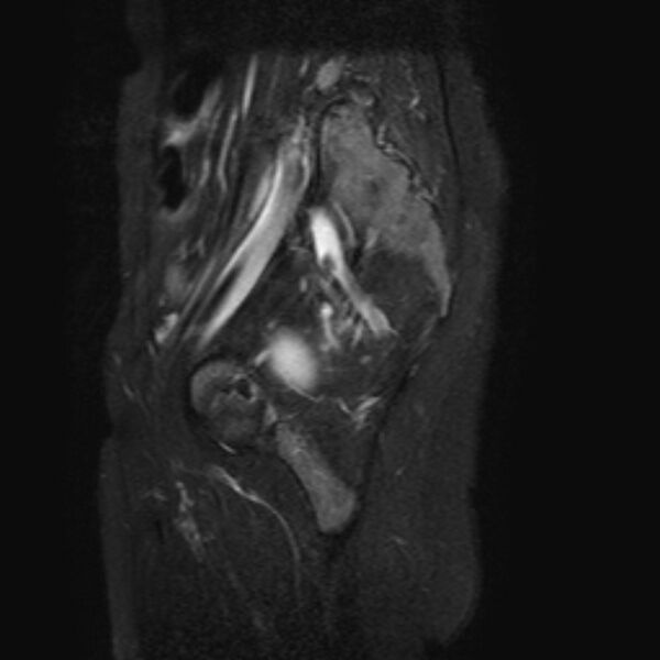File:Non-puerperal uterine inversion (Radiopaedia 78343-90983 Sagittal T2 fat sat 3).jpg