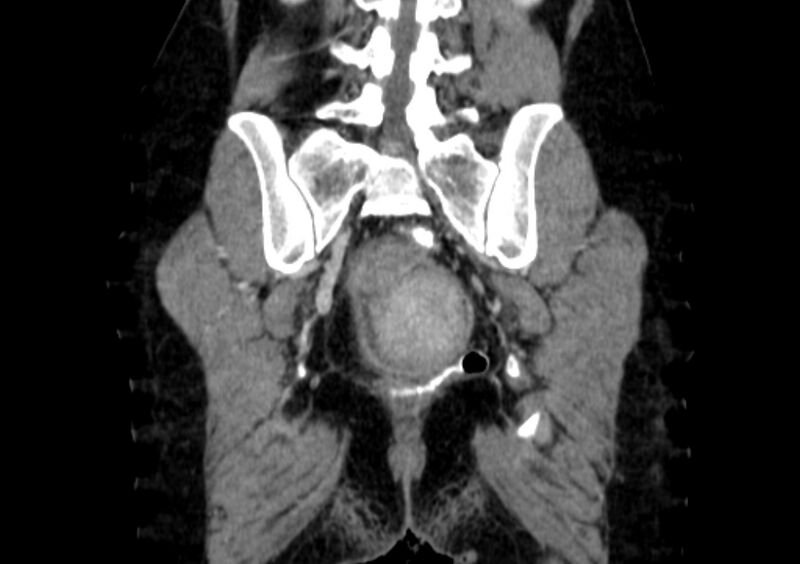 File:Non-puerperal uterine inversion (Radiopaedia 78343-91094 B 49).jpg