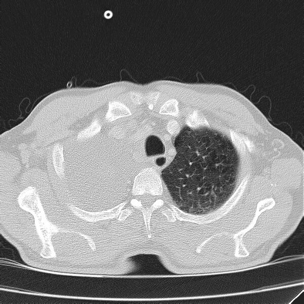 File:Non small-cell lung cancer (Radiopaedia 24467-24769 lung window 6).jpg