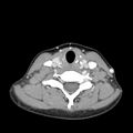 Normal CT of the neck (Radiopaedia 14575-14500 Axial C+ 48).jpg