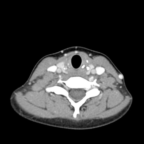 File:Normal CT of the neck (Radiopaedia 14575-14500 Axial C+ 48).jpg