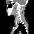 Normal CT of the neck (Radiopaedia 14575-14500 Sagittal C+ 20).jpg