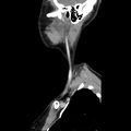 Normal CT of the neck (Radiopaedia 14575-14500 Sagittal C+ 9).jpg