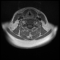 Normal cervical and thoracic spine MRI (Radiopaedia 35630-37156 Axial T1 C+ 16).png