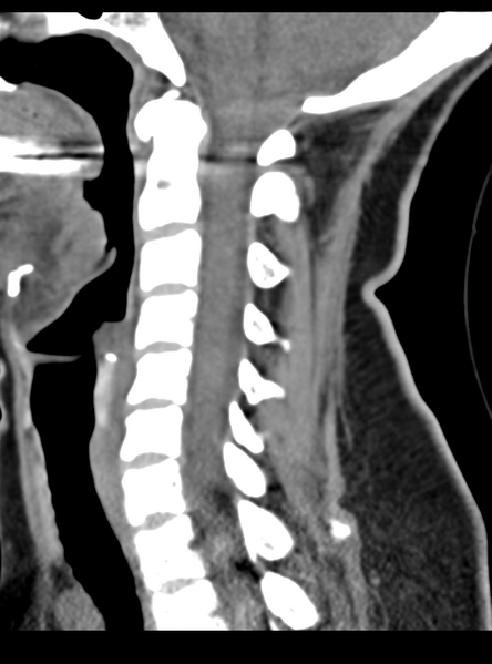 File:Normal cervical spine MRI (including Dixon) (Radiopaedia 42762-45926 C 31).png