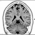 Normal coronal brain (Radiopaedia 6676-7910 B 31).jpg