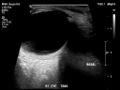 Normal eye ultrasound (Radiopaedia 70415-80514 A 7).jpg