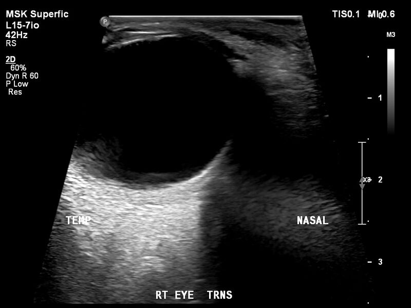 File:Normal eye ultrasound (Radiopaedia 70415-80514 A 7).jpg