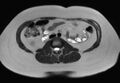 Normal liver MRI with Gadolinium (Radiopaedia 58913-66163 Axial T2 5).jpg