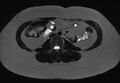 Normal liver MRI with Gadolinium (Radiopaedia 58913-66163 E 3).jpg