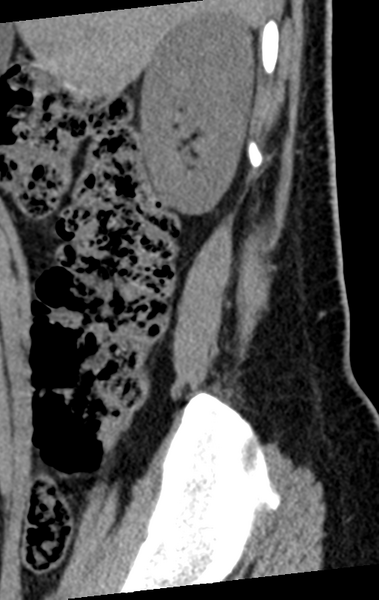 File:Normal lumbar spine CT (Radiopaedia 46533-50986 C 100).png