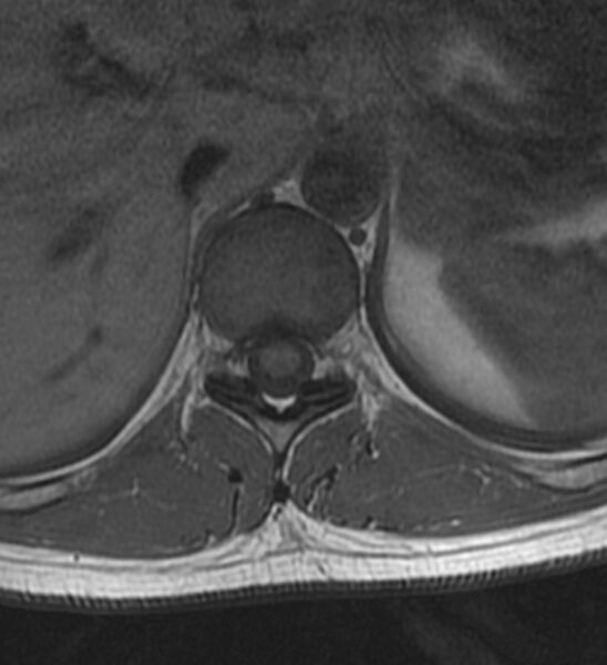 File:Normal thoracic spine MRI (Radiopaedia 41033-43781 Axial T1 19).jpg