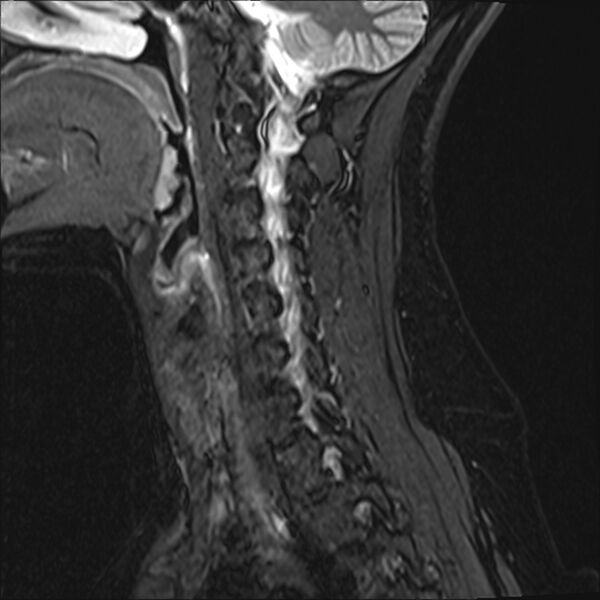File:Normal trauma cervical spine MRI (Radiopaedia 32130-33071 Sagittal STIR 4).jpg