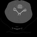 Normal trauma spine imaging (age 16) (Radiopaedia 45335-49358 Axial bone window 41).jpg