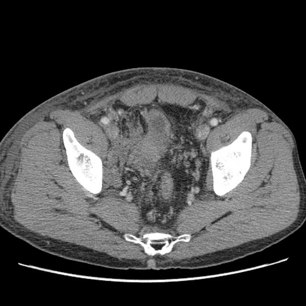 File:Obstructive bladder transitional cell carcinoma (Radiopaedia 9825-10410 A 29).jpg