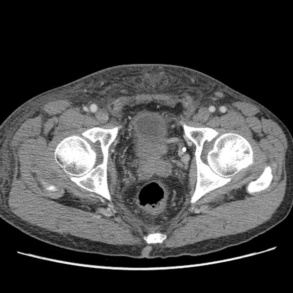 File:Obstructive bladder transitional cell carcinoma (Radiopaedia 9825-10410 A 34).jpg