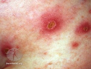 See more images of ecthyma. (DermNet NZ bacterial-ecthyma).jpg
