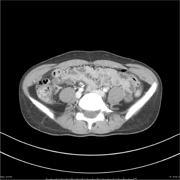 File:Traumatic renal artery dissection and pancreatic transection (Radiopaedia 37061-38739 Axial 220).jpg