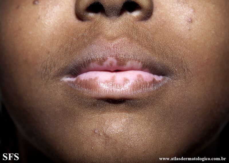 File:Vitiligo (Dermatology Atlas 67).jpg