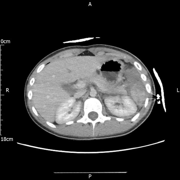 File:AAST grade IV kidney injury with CEUS follow-up (Radiopaedia 72353-82877 Axial C+ portal venous phase 19).jpg