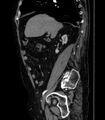 Abdominal aortic aneurysm (Radiopaedia 25855-26001 Sagittal C+ arterial phase 3).jpg