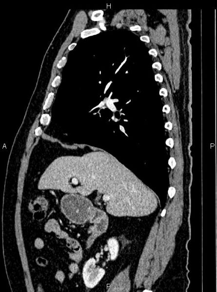 File:Abdominal aortic aneurysm (Radiopaedia 83094-97462 Sagittal renal cortical phase 45).jpg