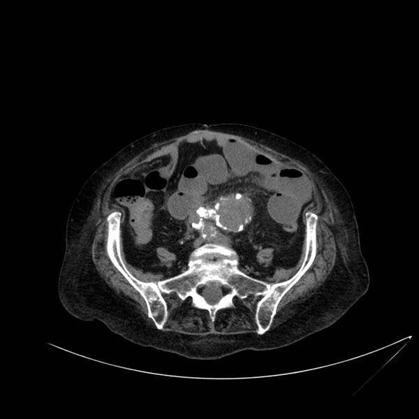 File:Abdominal aortic aneurysm - impending rupture (Radiopaedia 19233-19246 Axial non-contrast 88).jpg