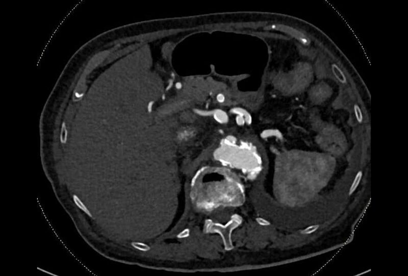 File:Abdominal aortic aneurysm with thrombus fissuration (Radiopaedia 73192-83919 Axial C+ arterial phase 29).jpg