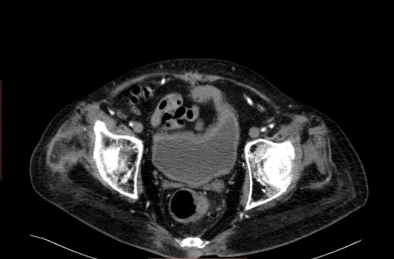 File:Abdominal aortic interposition tube graft and aneurysm thrombosis (Radiopaedia 71438-81857 Axial C+ arterial phase 215).jpg