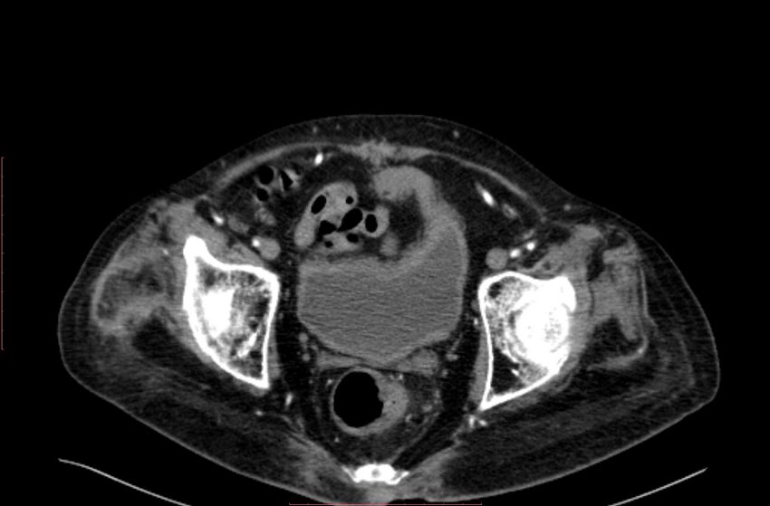 Abdominal aortic interposition tube graft and aneurysm thrombosis (Radiopaedia 71438-81857 Axial C+ arterial phase 215).jpg