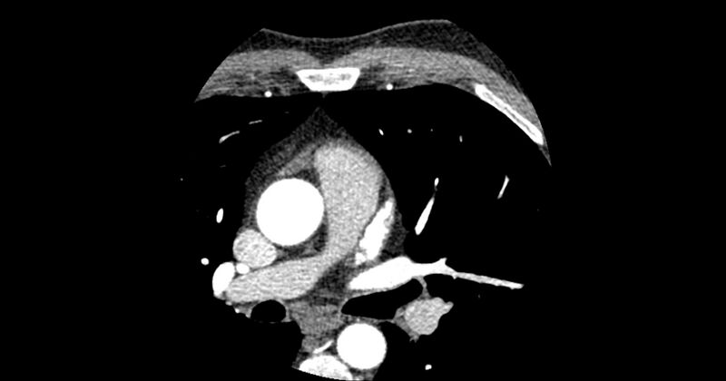 File:Aberrant left main coronary artery (ALMCA) arising from the right sinus with interarterial course (Radiopaedia 63251-71814 Axial C+ arterial phase 35).JPG
