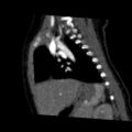 Aberrant left pulmonary artery (pulmonary sling) (Radiopaedia 42323-45435 Sagittal C+ arterial phase 35).jpg