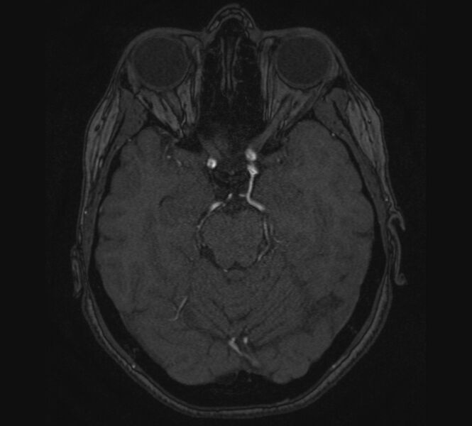 File:Accessory middle cerebral artery and ICA aneurysm (Radiopaedia 22656-22674 MRA 39).jpg