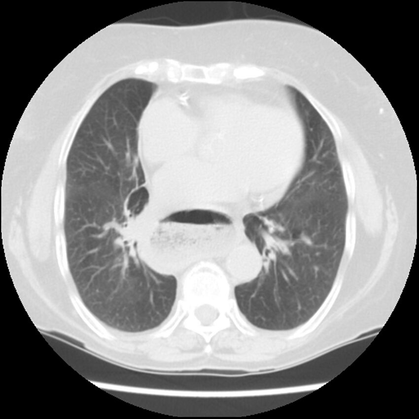 Achalasia (Radiopaedia 44094-47649 Axial lung window 36).jpg