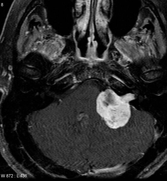File:Acoustic schwannoma (large with cystic change) (Radiopaedia 5369-7130 Axial T1 C+ fat sat 6).jpg