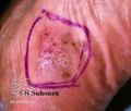 Acral lentignous melanoma (DermNet NZ lesions-melanoma-s-alm5).jpg