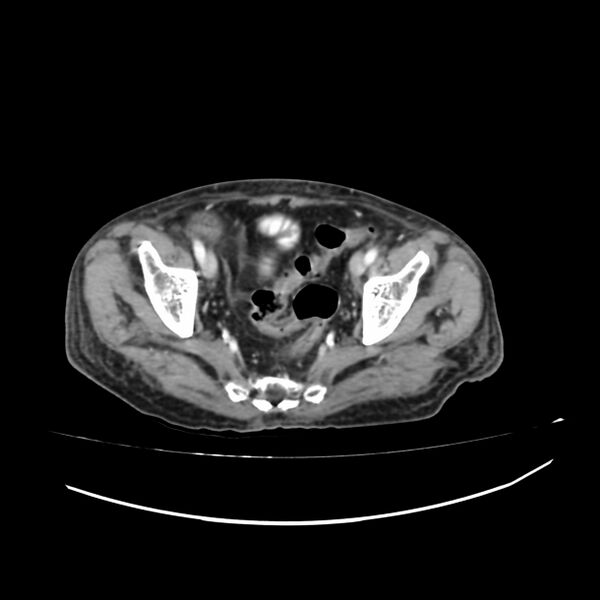 File:Acute-on-chronic Crohn disease with enteroenteric fistula (Radiopaedia 66686-75987 B 68).jpg