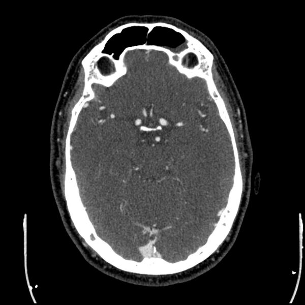 File:Acute A3 occlusion with ACA ischemic penumbra (CT perfusion) (Radiopaedia 72036-82527 Axial C+ arterial phase thins 106).jpg