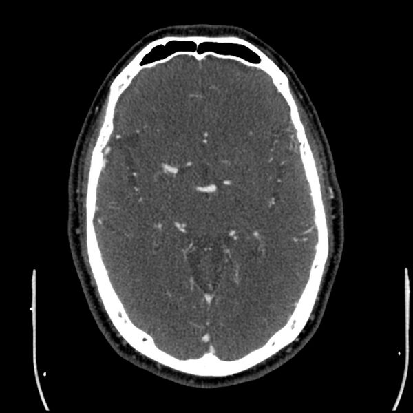 File:Acute A3 occlusion with ACA ischemic penumbra (CT perfusion) (Radiopaedia 72036-82527 Axial C+ arterial phase thins 85).jpg