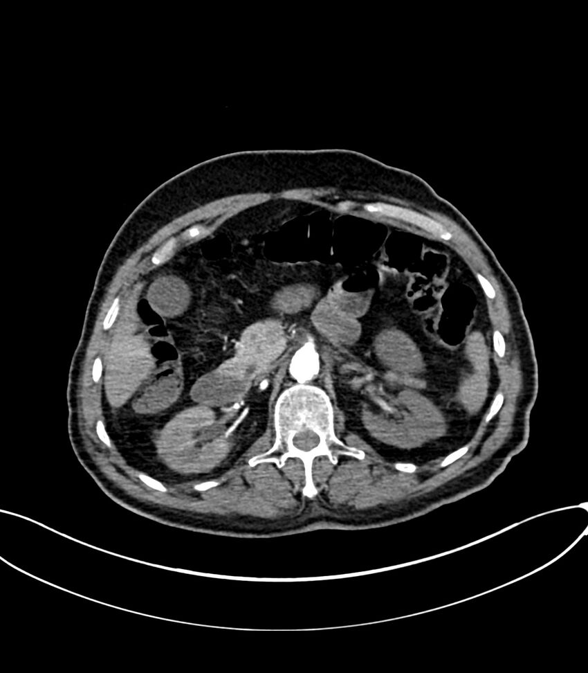 Acute arterial mesenteric ischemia (Radiopaedia 78238-90828 Axial C+ arterial phase 48).jpg