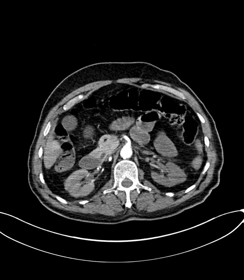 Acute arterial mesenteric ischemia (Radiopaedia 78238-90828 Axial C+ arterial phase 49).jpg