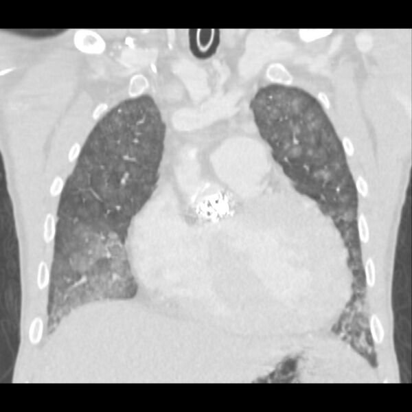 File:Acute diffuse alveolar hemorrhage (Radiopaedia 41323-44158 Coronal lung window 13).jpg