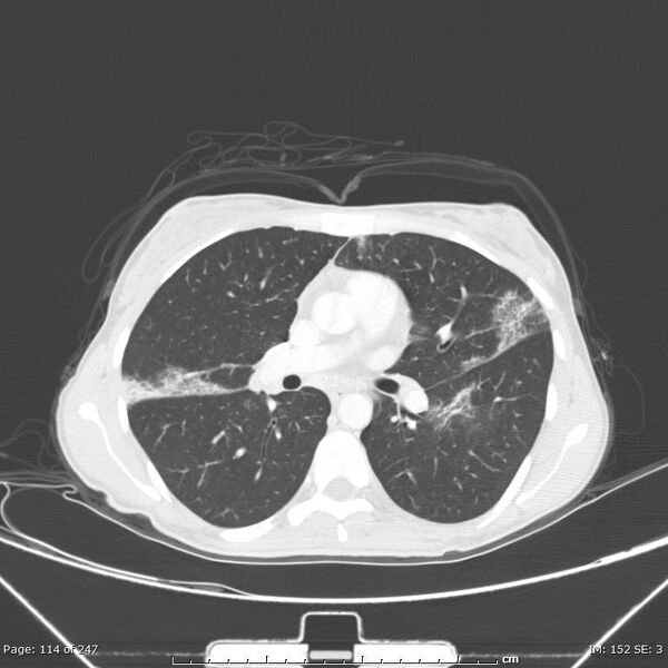 File:Acute eosinophilic pneumonia (Radiopaedia 48211-53073 Axial 18).jpg