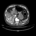 Acute heart failure (CT) (Radiopaedia 79835-93075 Axial C+ arterial phase 80).jpg