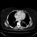 Acute pancreatitis - Balthazar C (Radiopaedia 26569-26714 Axial C+ portal venous phase 11).jpg