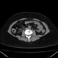 Acute pancreatitis - Balthazar C (Radiopaedia 26569-26714 Axial non-contrast 53).jpg