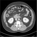 Acute pancreatitis - mild (Radiopaedia 27796-28033 C+ portal venous phase 24).jpg